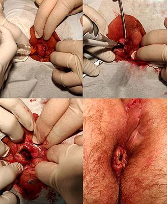 Safety and Effectiveness of Tailored Hemorrhoidectomy in Outpatients Setting